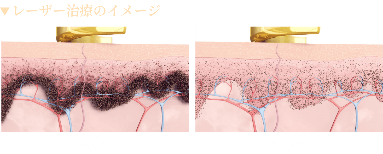 レーザー治療のイメージ
